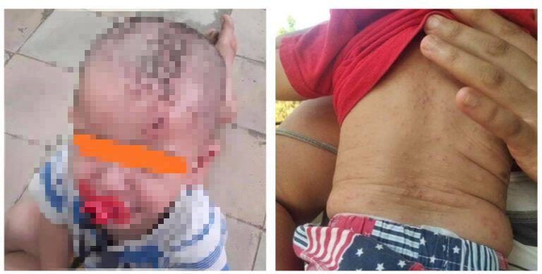 Crece el número de personas con sarna en Cuba, y los niños pequeños son los principales afectados