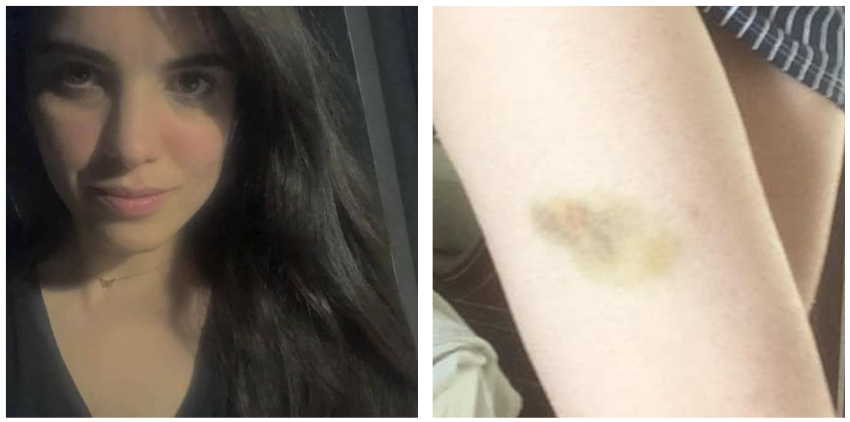 La Cuba del horror: Activista Carolina Barrero con moretones en su cuerpo tras ser liberada por la Seguridad del Estado