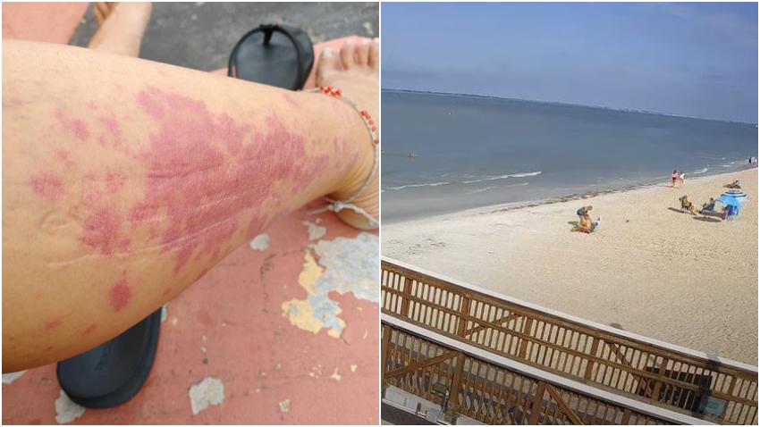 Mujer en Florida asegura que se contagió en la playa de Fort Myers con la bacteria "come carne"