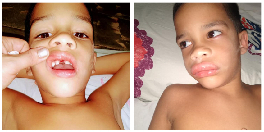 Padres cubanos pagan 1.200 por tratamiento para su hijo, en la mal denominada "potencia médica", donde supuestamente la salud es gratuita