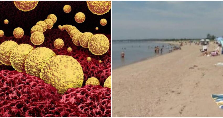 Autoridades sanitarias de Florida confirman muerte de cinco personas y 23 infectados por bacteria come carne en playas del estado Come carne-playa