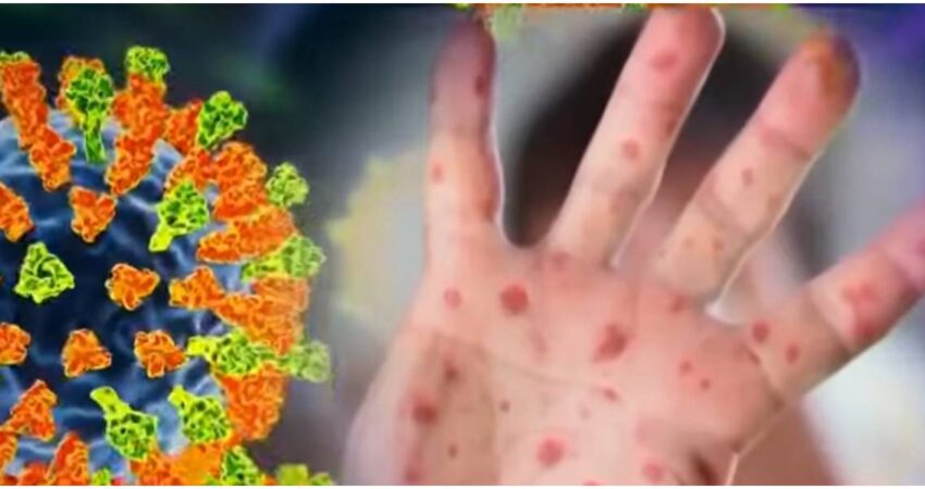 Alerta de los CDC: Florida ya es el tercer estado con mรกs casos de sarampiรณn en EE.UU sarampiรณn